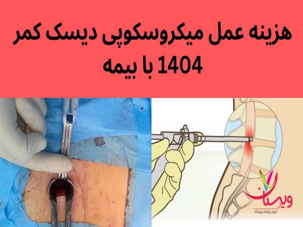 عمل میکروسکوپی دیسک کمر هزینه عمل میکروسکوپی دیسک کمر 1404 با بیمه