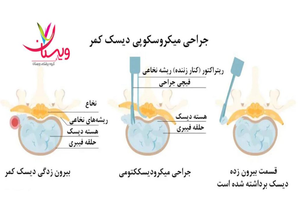 بیمه سلامت هزینه عمل میکروسکوپی دیسک کمر با بیمه سلامت