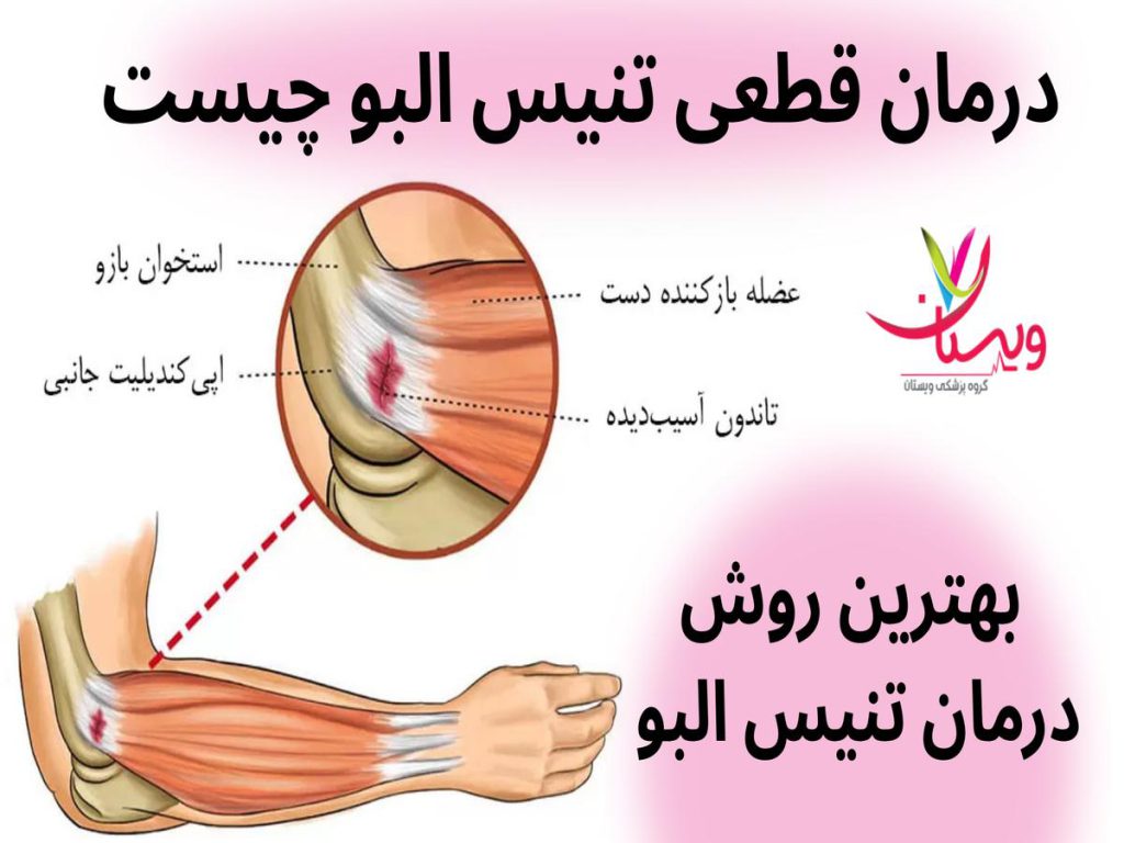 بهترین روش درمان تنیس البو