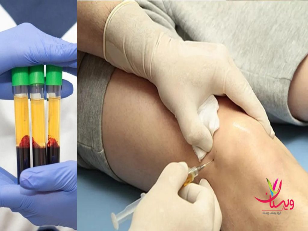 درمان مشکلات زانو بهترین مرکز پی آر پی زانو در تهران