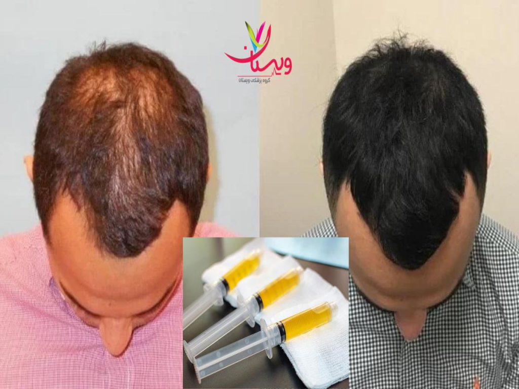 تقویت رشد مو بهترین مرکز پی آر پی مو در تهران