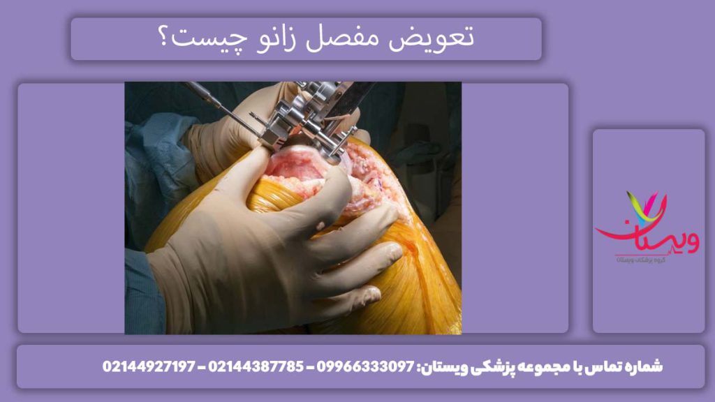 تعویض کامل زانو تعویض مفصل زانو چه روشی است؟