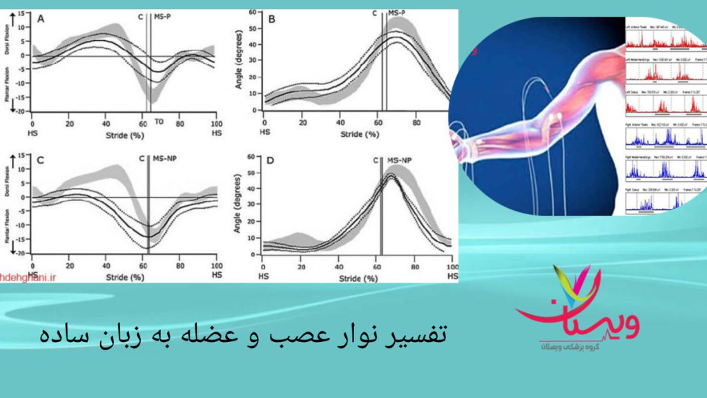 ترکیب گراف های علمی با تصویر شماتیک بدن نمایی از تفسیر نوار عصب و عضله و مسیر سیگنال های عصبی