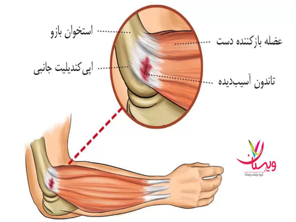 متخصص طب سنتی درمان تنیس البو با متخصص طب سنتی