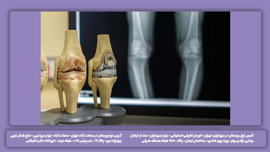 چگونگی راه رفتن بعد از پروتز حرکت کردن بعد از جراحی زانو چگونه است؟