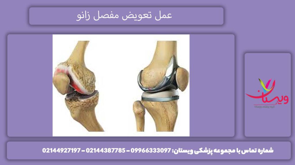 تعویض مفصل زانو چیست؟