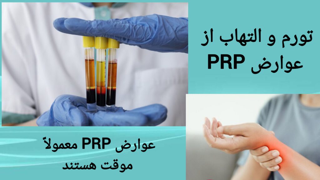 عوارض احتمالی پی آر پی مچ دست مچ دست بیمار بعد از انجام پی آر پی ملتهب و قرمز شده است