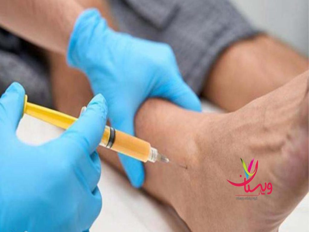 پی آرپی مچ پا عوامل موثر بر هزینه پی آرپی مچ پا