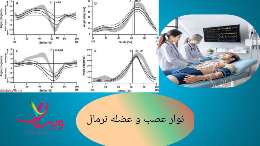 بررسی نوار عصب و عضله نرمال برای تشخیص عملکرد سالم عضلات نوار عصب و عضله نرمال و پزشک در حال انجام نوار عصب و عضله برای بیمار