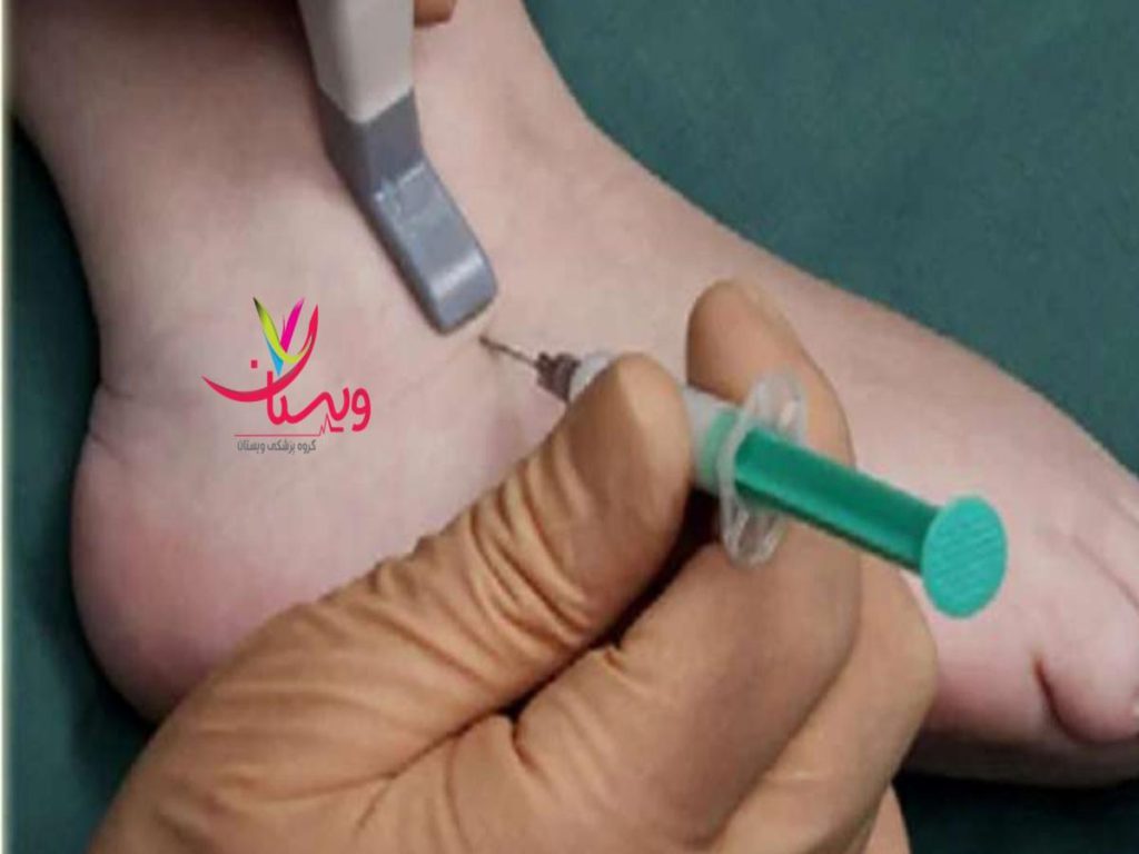 بیمه تکمیلی درمانی هزینه پی آرپی مچ پا با بیمه