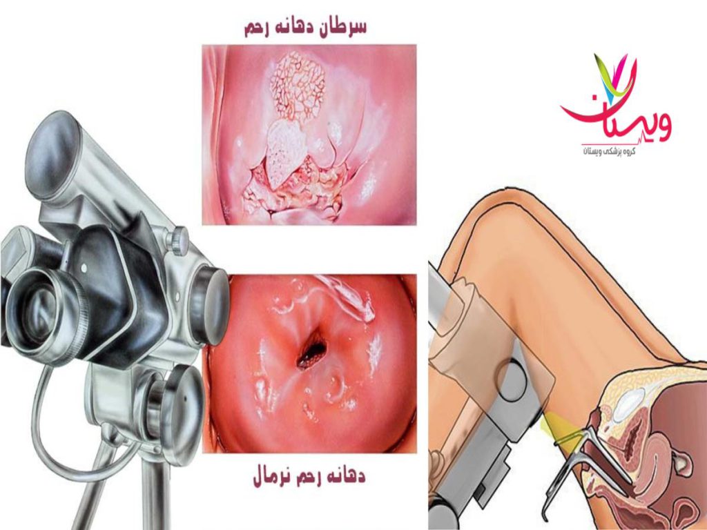 بیمه نیروهای مسلح هزینه کولپوسکوپی با بیمه نیروهای مسلح