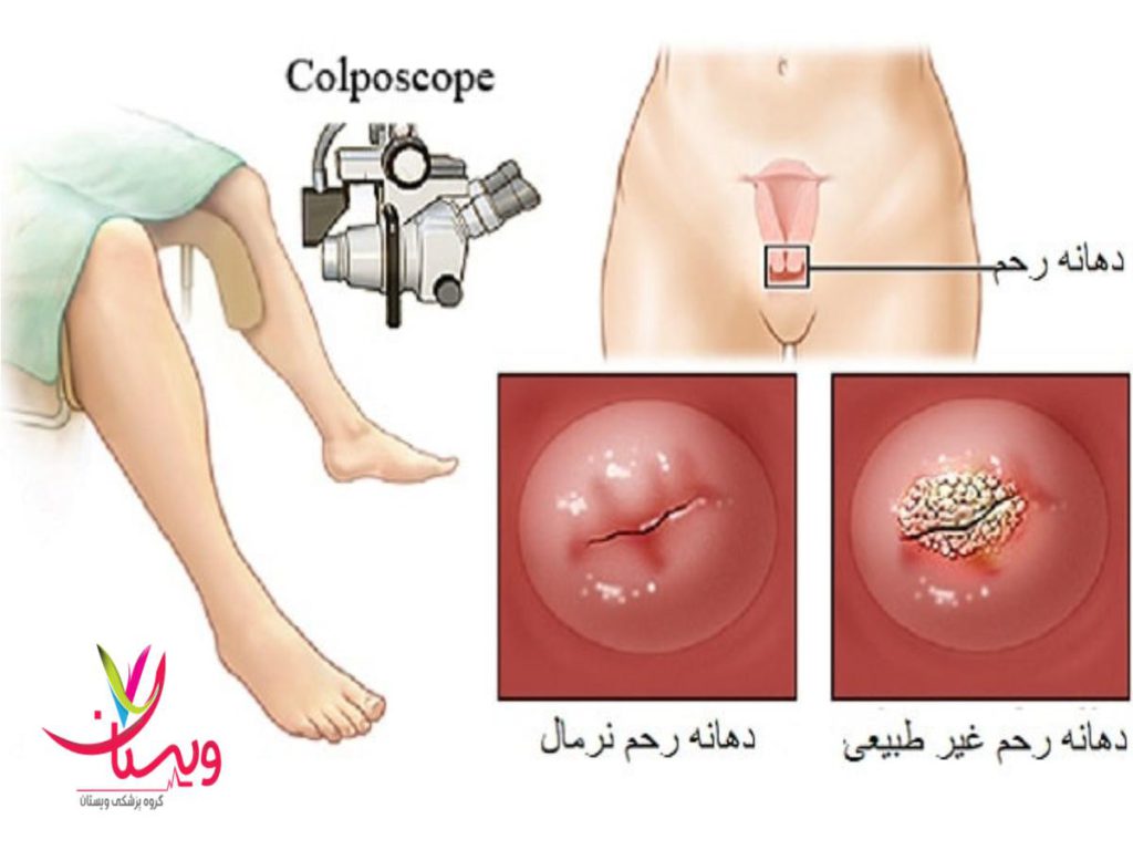 ناهنجاریهای واژنی هزینه کولپوسکوپی در مطب