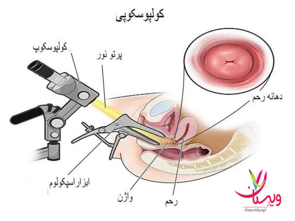 تغییرات پیش سرطانی هزینه کولپوسکوپی زگیل تناسلی