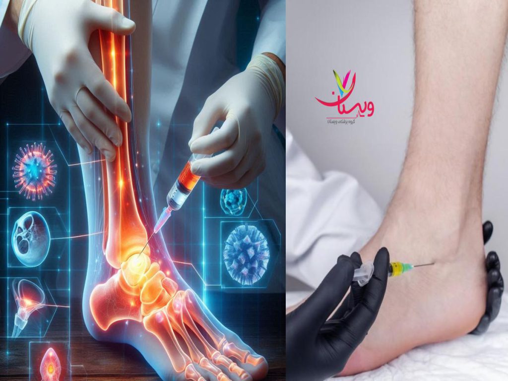 کاهش درد مچ پا پی آر پی مچ پا چه مزایایی دارد