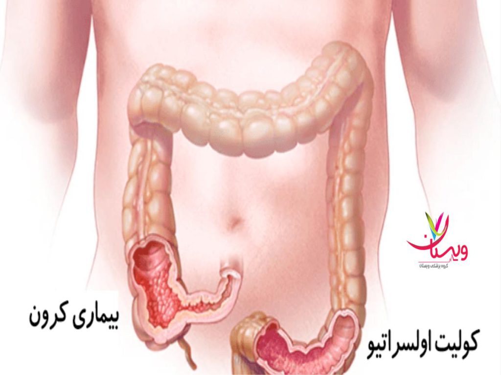 لایههای دیواره روده آیا بیماری کرون خطرناک است
