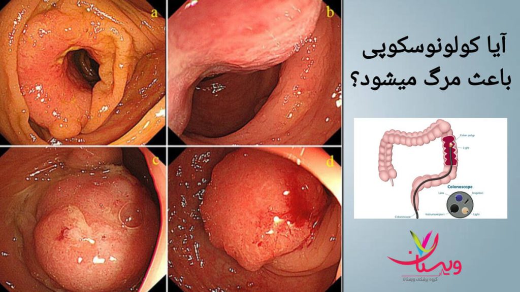 بررسی دقیق روده بزرگ با کولونوسکوپی