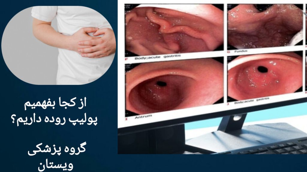 دل درد در افرادی که پولیپ روده دارند. فردی که به دلیل پولیپ روده، دچار دل درد شده است.