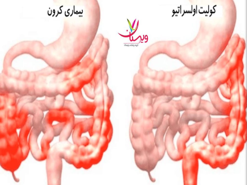 کولونوسکوپی ایا بیماری کرون سرطان است