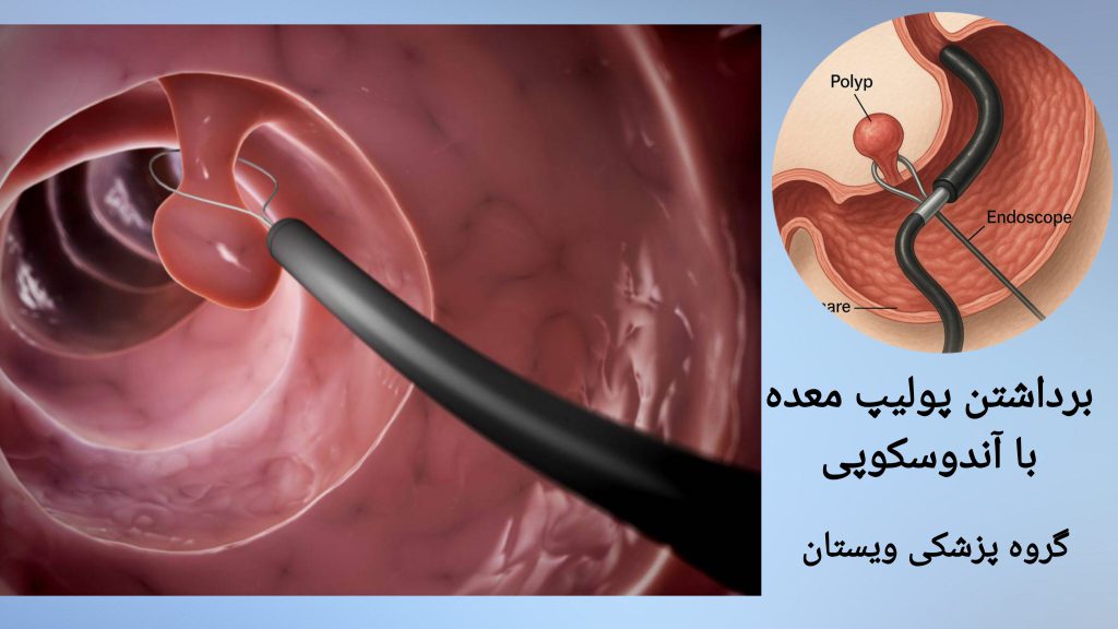 برداشتن پولیپ معده به وسیله آندوسکوپی نمایی از برداشتن پولیپ معده با آندوسکوپی