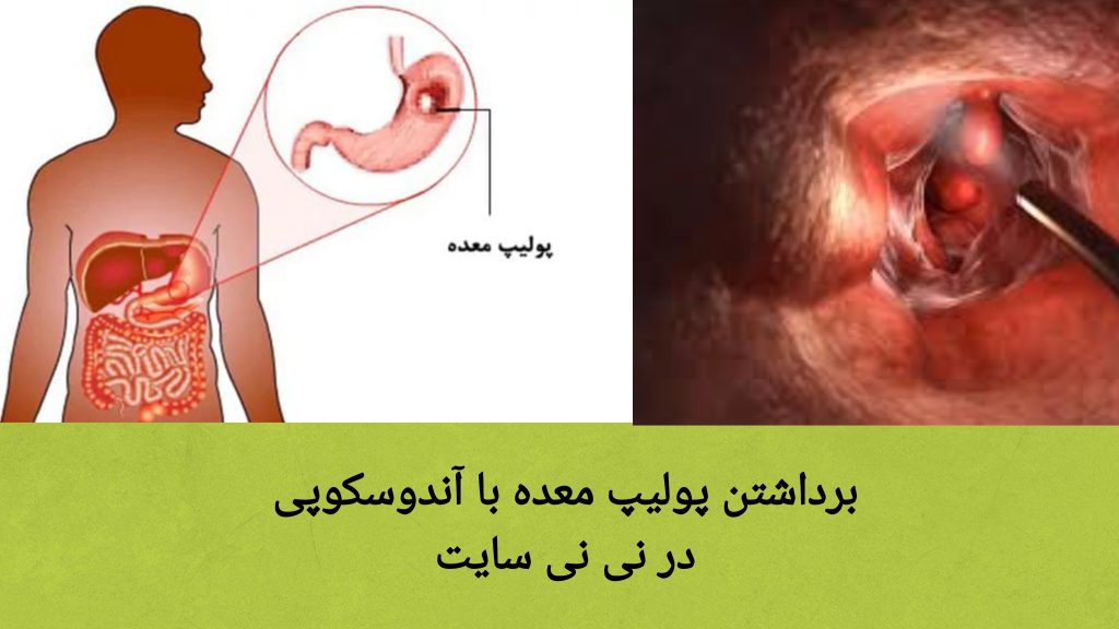 پولیپ معده در بدن بیمار نمایی از بدن انسان و پولیپ معده