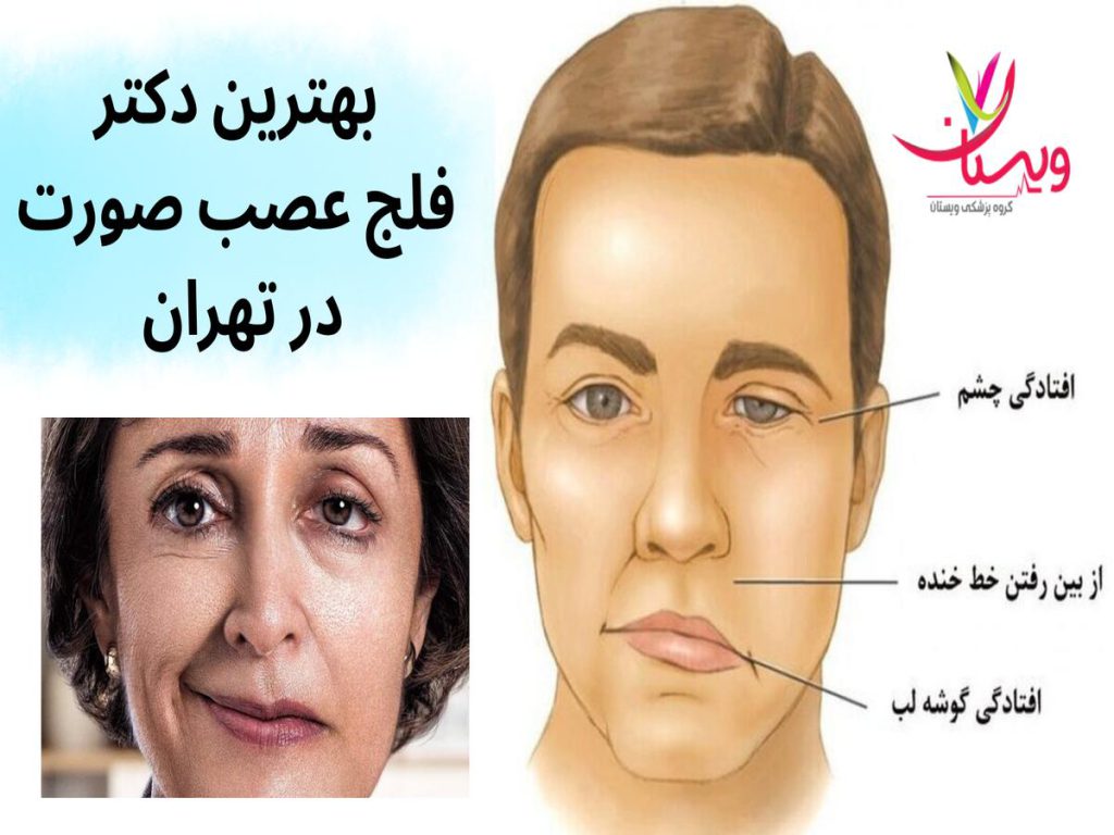 دکتر فلج عصب صورت بهترین دکتر فلج عصب صورت در تهران
