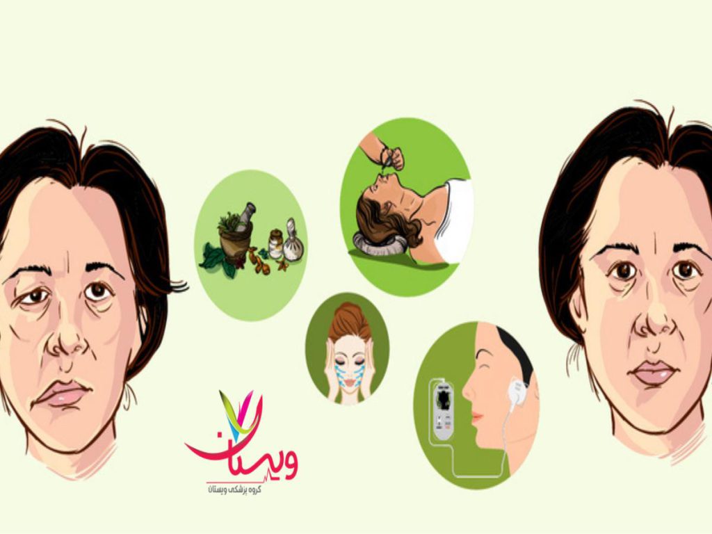 فلج عصب صورت بیماری های مغزی