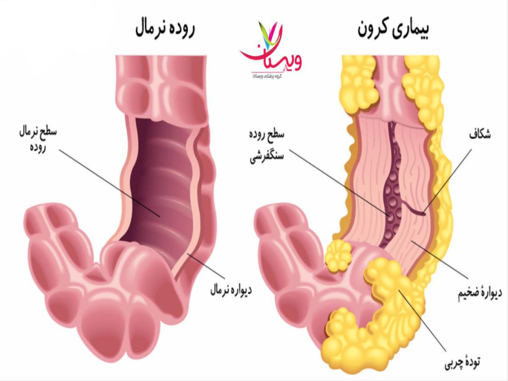 انتهای روده باریک بیماری کرون چیست