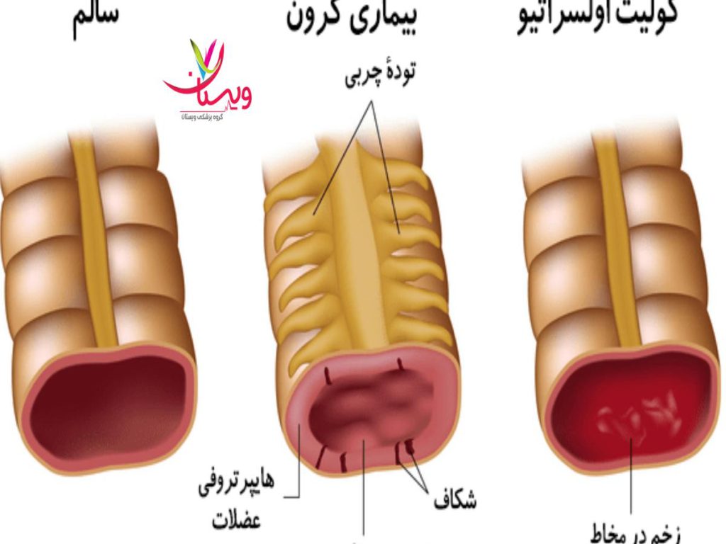 داروهای بیولوژیک تجربیات بیماران مبتلا به کرون