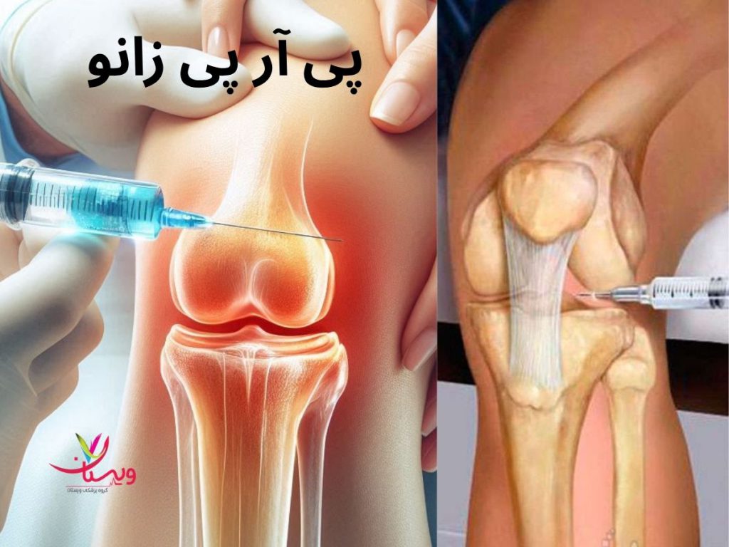 prp knee پی آرپی زانو یا تزریق پلاسمای غنی از پلاکت چیست؟