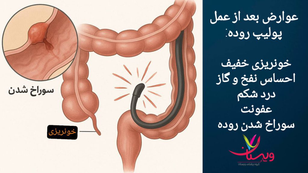 خونریزی روده بعد از برداشتن پولیپ روده روده بیمار که دچار خونریزی بعد از عمل برداشتن پولیپ معده شده است.