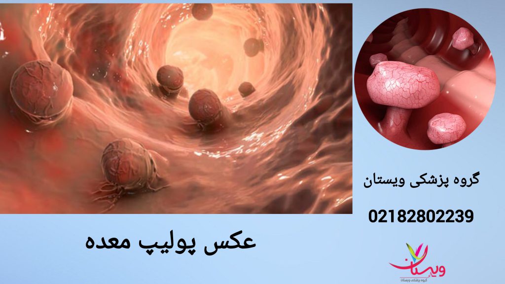 عکسی از پولیپ معده بیمار نمایی از عکس پولیت معده