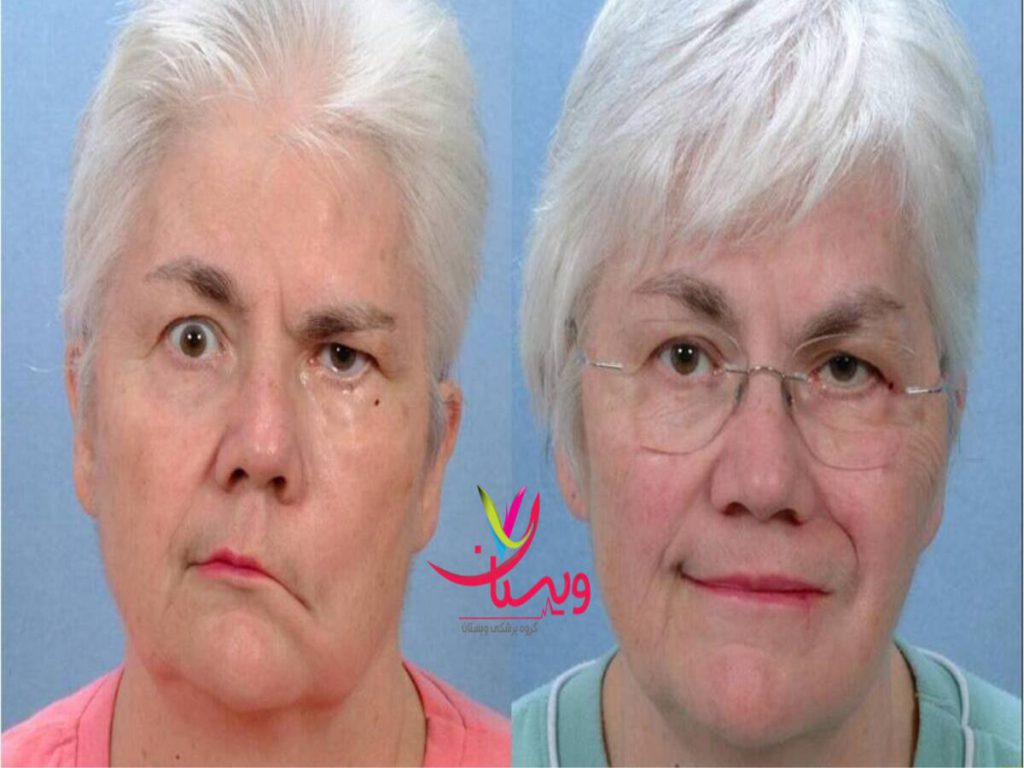 جراح مغز و اعصاب ویژگی بهترین دکتر فلج عصب صورت