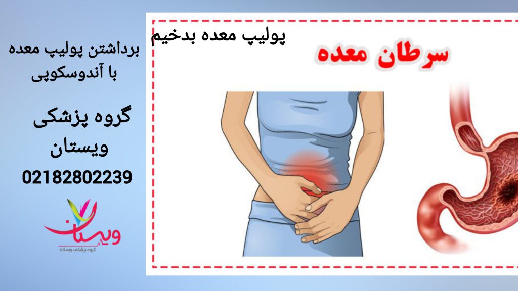 پولیپ معده بدخیم و سرطانی شخصی که دچار پولیپ معده بد خیم شده است