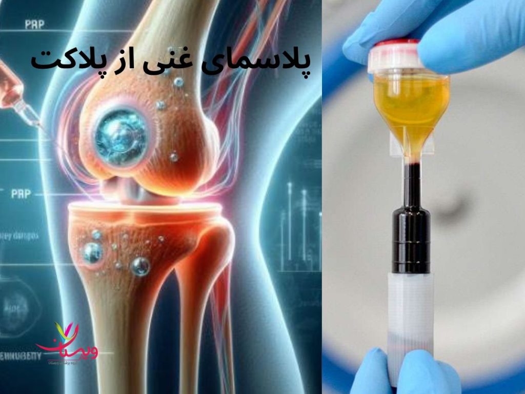 جلسات پی آر پی پی آر پی زانو چند جلسه است