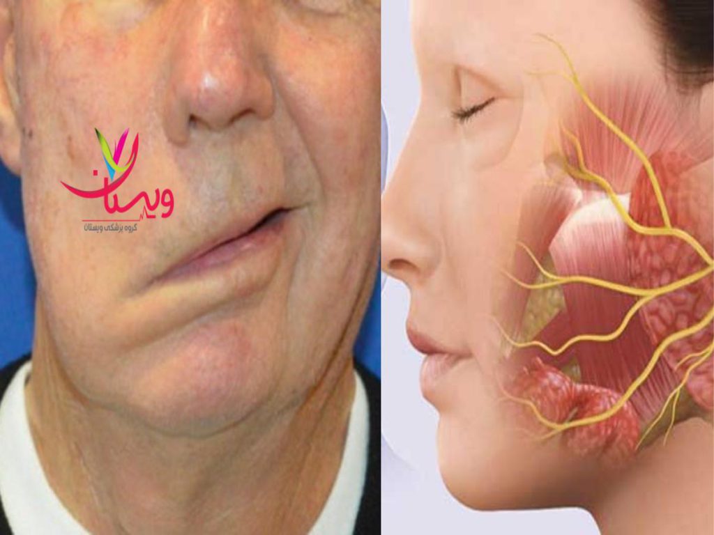 جراح پلاستیک چگونه بهترین دکتر فلج عصب صورت پیدا کنم
