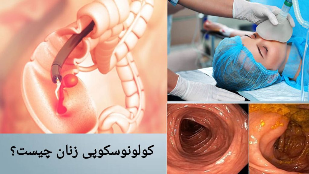 بیهوش کردن بیمار خانم، برای کولونوسکوپی پزشک برای انجام کولونوسکوپی، بیمار خانم را بیهوش می کند.