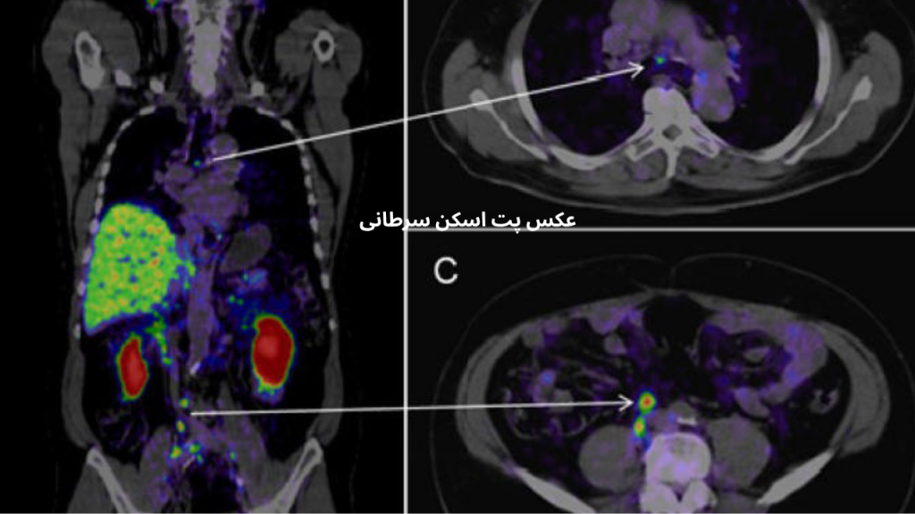 عکس پت اسکن سرطانی