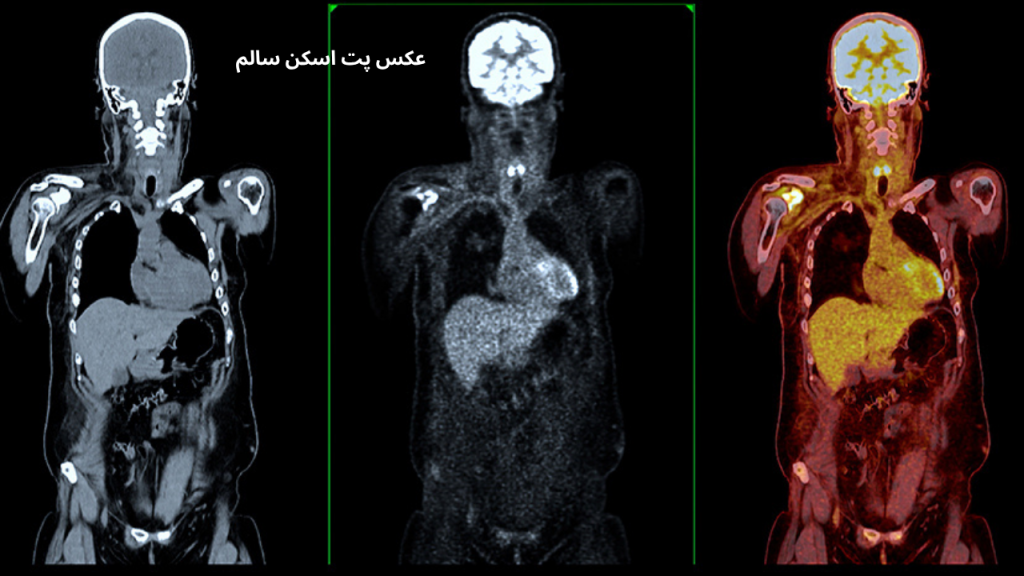 عکس پت اسکن سالم