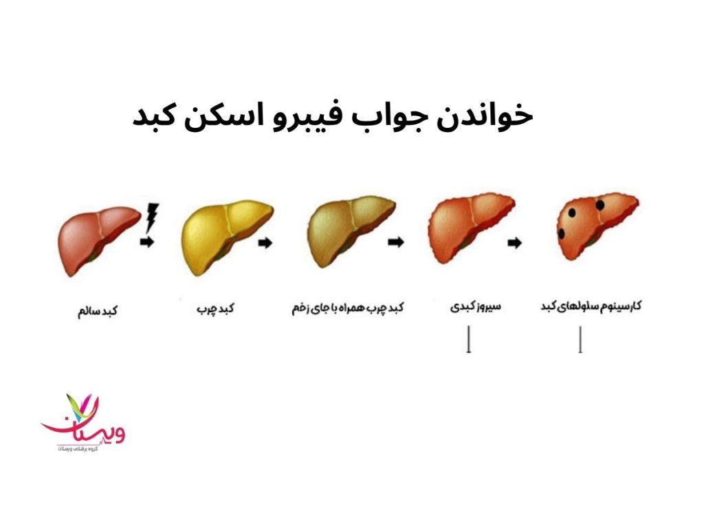 جواب تست فیبرو اسکن کبد خواندن جواب فیبرو اسکن کبد