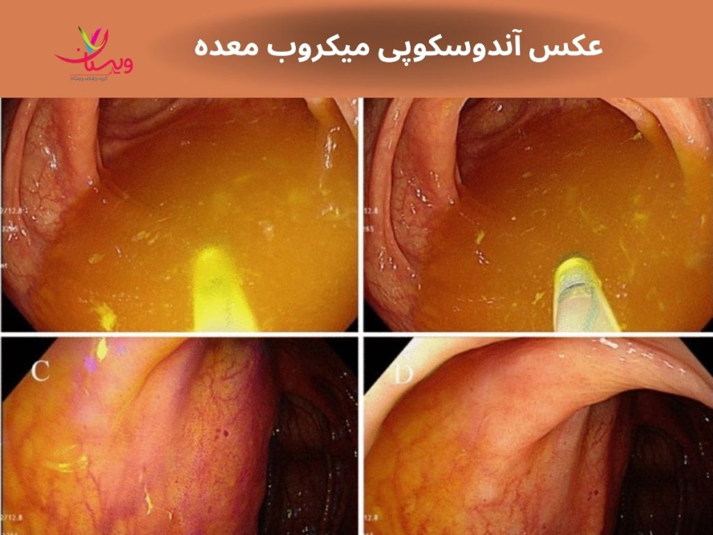 عکس آندوسکوپی میکروب معده
