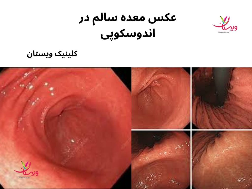 عکس معده سالم در اندوسکوپی- جواب کولونوسکوپی نرمال