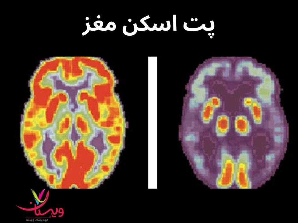 عکس پت اسکن سالم و عکس پت اسکن سرطانی