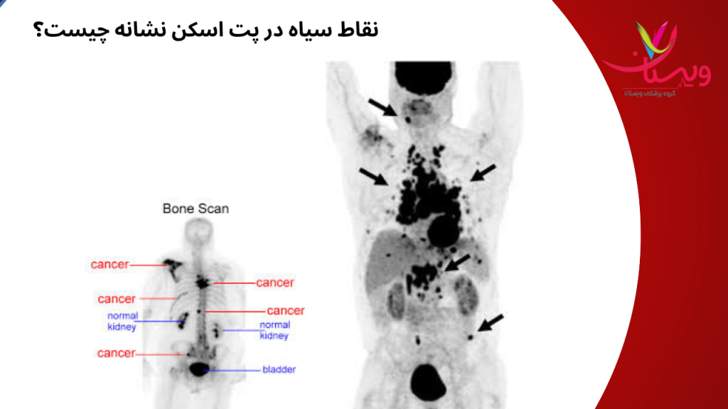 black spot نقاط سیاه در پت اسکن