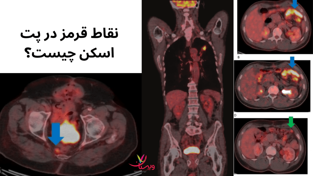 red spot نقاط قرمز در پت اسکن چیست؟