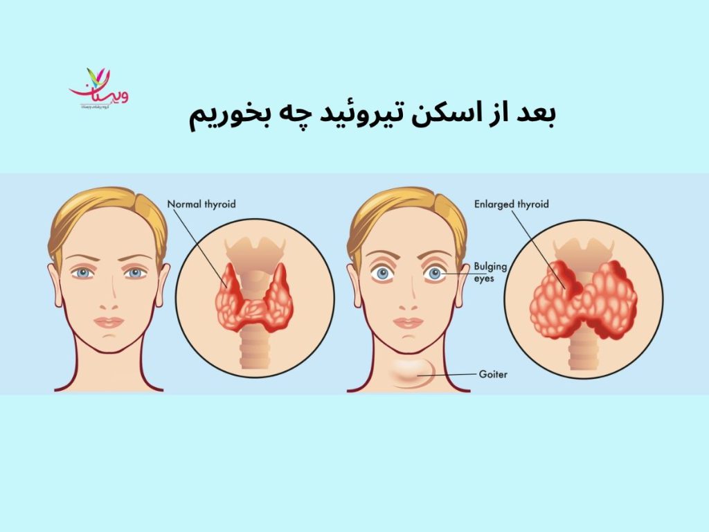 تغذیه بعد از اسکن تیر.ئید بعد از اسکن تیروئید چه بخوریم