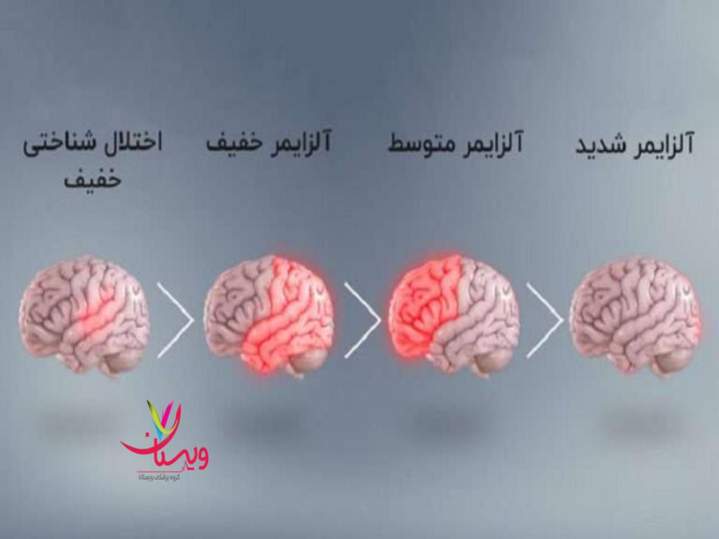 فرسودگی زودرس سیستم ایمنی و عصبی آلزایمر و مرگ زودرس