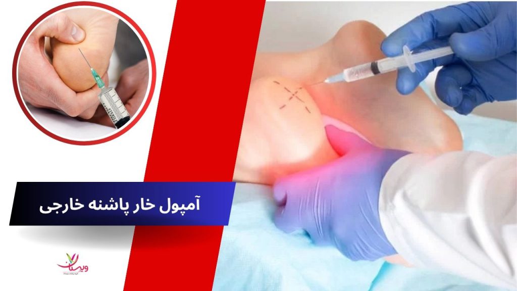 دیپروسپان (Diprosone) خارپاشنه آمپول خارجی برای خارپاشنه