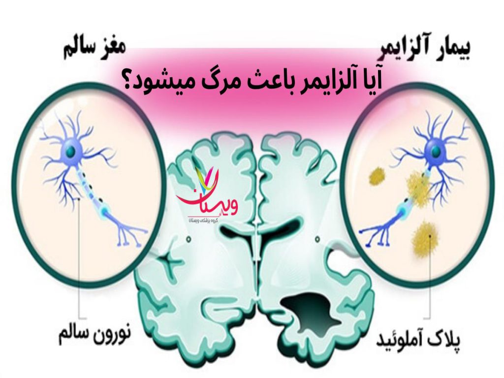آیا آلزایمر باعث مرگ میشود؟