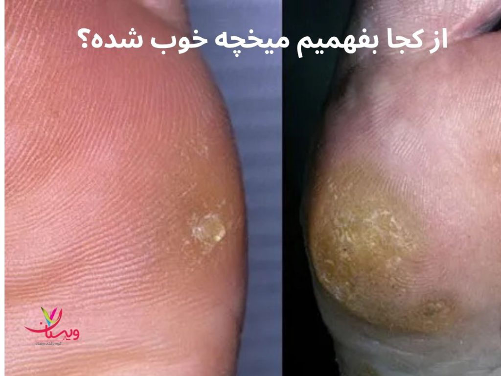 از کجا بفهمیم میخچه خوب شده