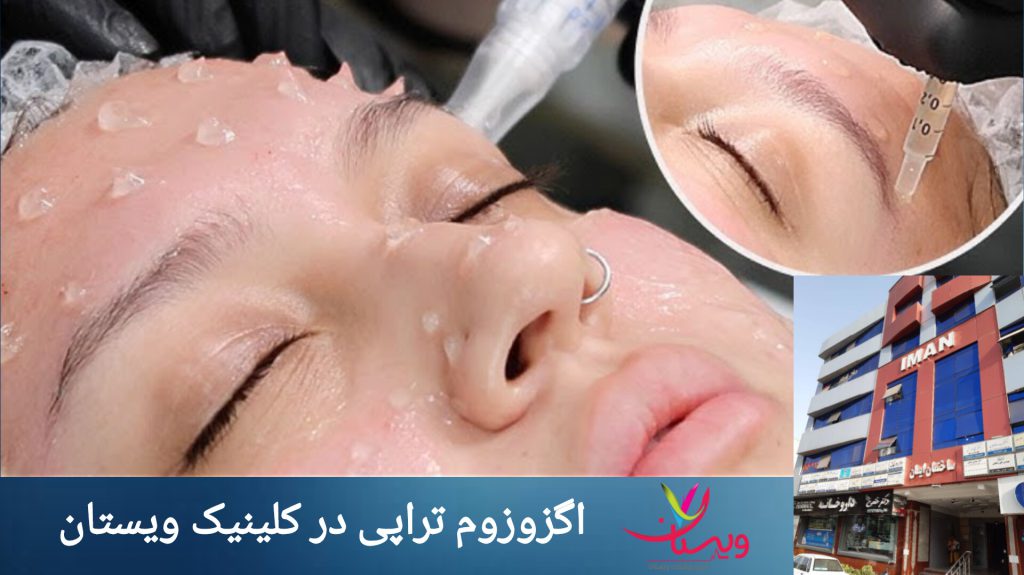 اگزوزوم صورت در ویستان انجام اگزوزوم تراپی صورت در کلینیک ویستان